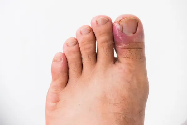 Ongles incarnés