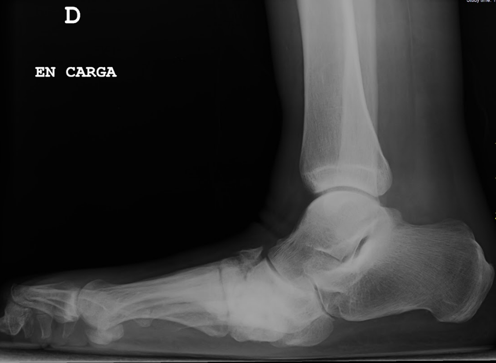 Qué es el pie de Charcot, qué lo causa y cómo se diagnostica