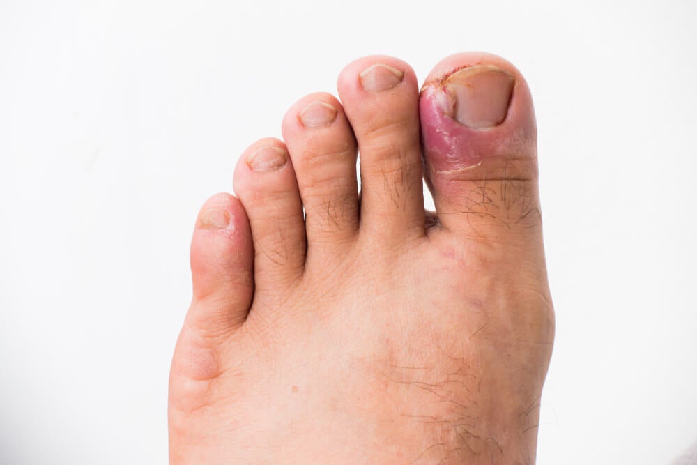 Uñas encarnadas