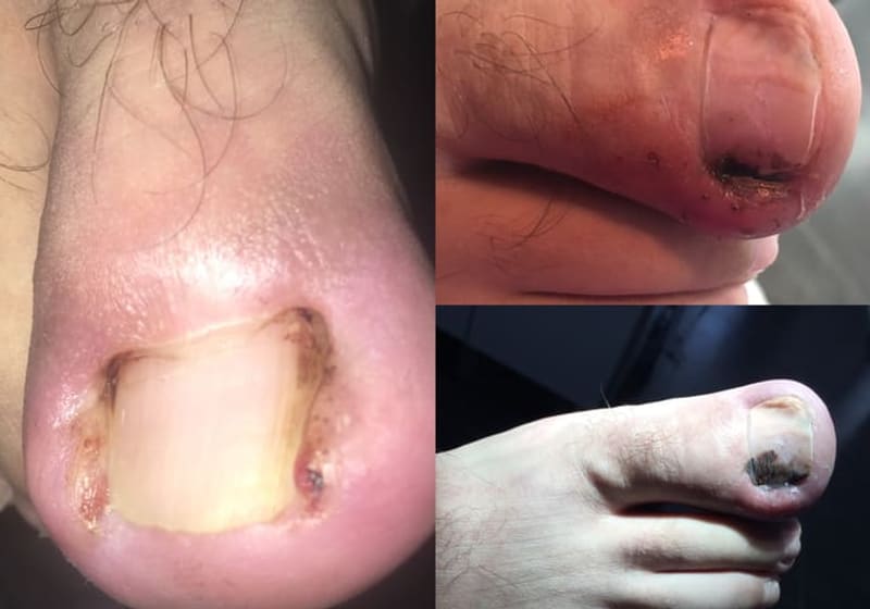 Verrugas plantares: cuándo consultar
